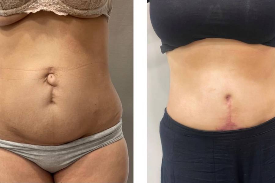 Abdominal Wall Reconstruction