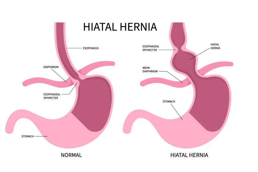 Hiatal Hernia 3