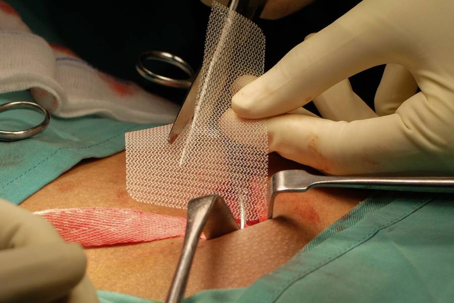 Open Hernia Repair