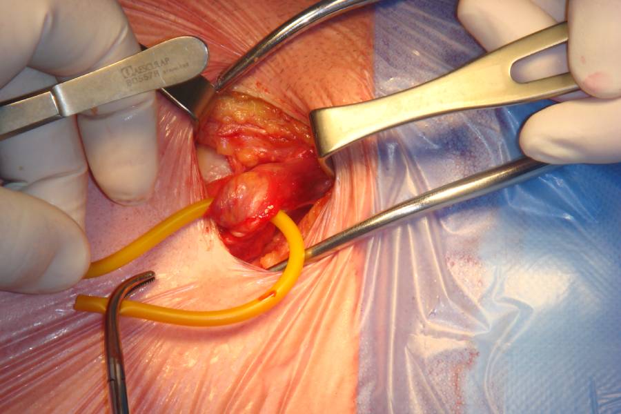 Recurrent Complex Hernia