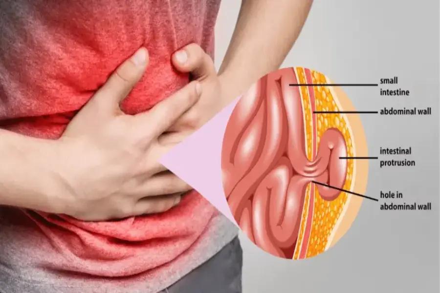Recurrent Hernia Why Choose a Specialist