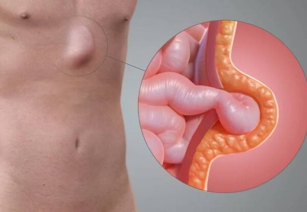 Recurrent Hernia_ Why Choosing a Specialist Matters for Your Long-Term Recovery