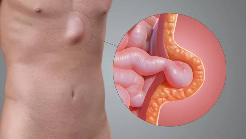 Recurrent Hernia Why Choosing a Specialist Matters for Your Long Term Recovery