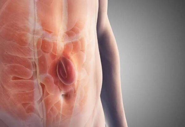 Why Hernias Recur_ Understanding and Avoiding Recurrence