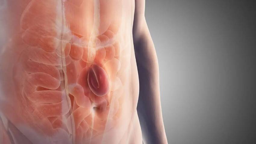 Why Hernias Recur Understanding and Avoiding Recurrence