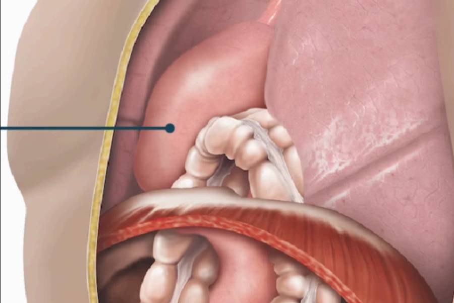 Adult Diaphragmatic Hernia A Rare but Critical Diagnosis