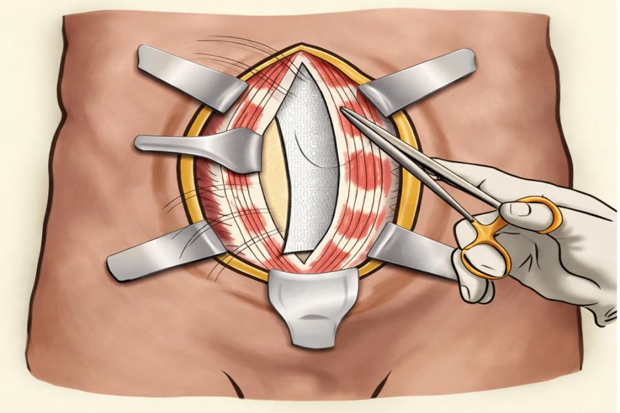 Open Abdominal Wall Reconstruction