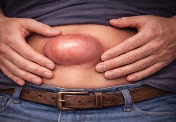 Silent Signs You Have a Hernia