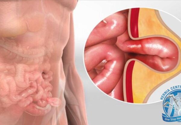 Dr. Pinak Dasgupta explaining the best treatment options for hernia including open, laparoscopic and robotic surgery