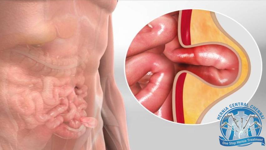 Dr. Pinak Dasgupta explaining the best treatment options for hernia including open, laparoscopic and robotic surgery