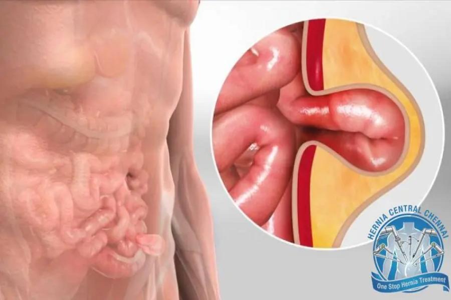 What Is the Best Treatment for a Hernia