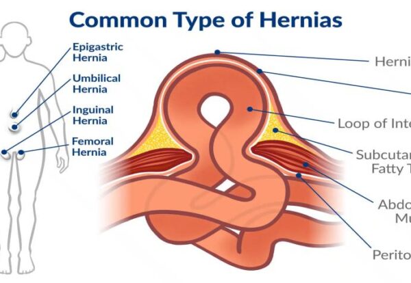 Types of hernias and modern treatment options explained by Dr Pinak Dasgupta