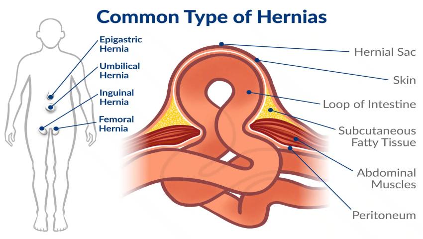 Types of hernias and modern treatment options explained by Dr Pinak Dasgupta